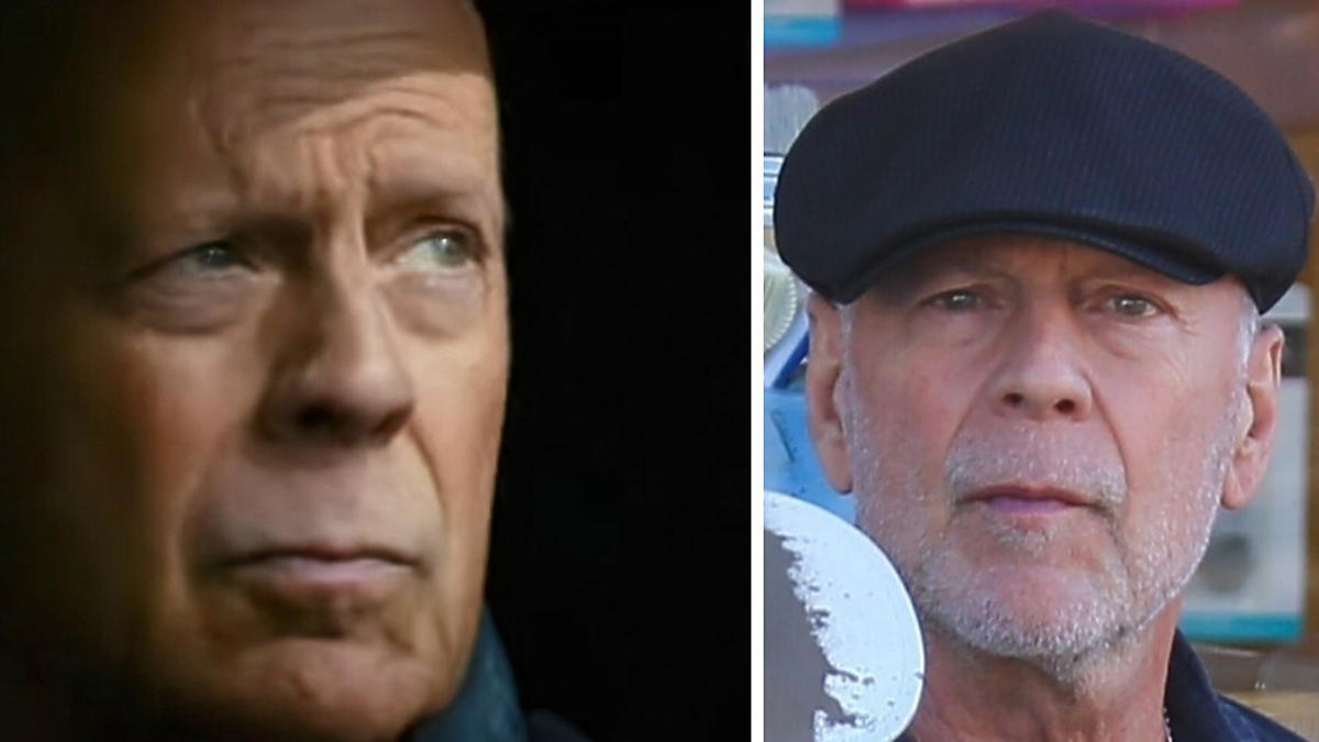 Czym jest afazja, na którą choruje Bruce Willis? Czym jest afazja, na którą choruje Bruce Willis?