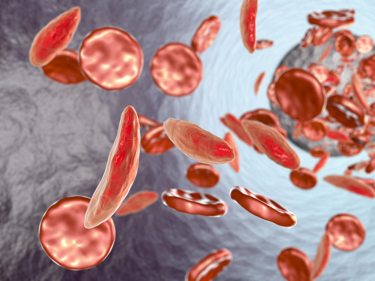 czerwone krwinki w przebiegu anemii