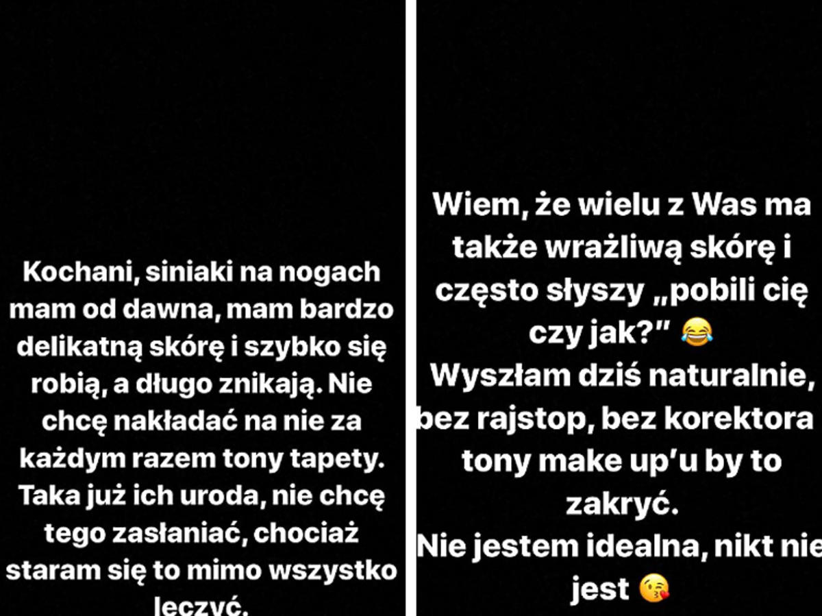 Julia Wróblewska pokazała posiniaczone nogi