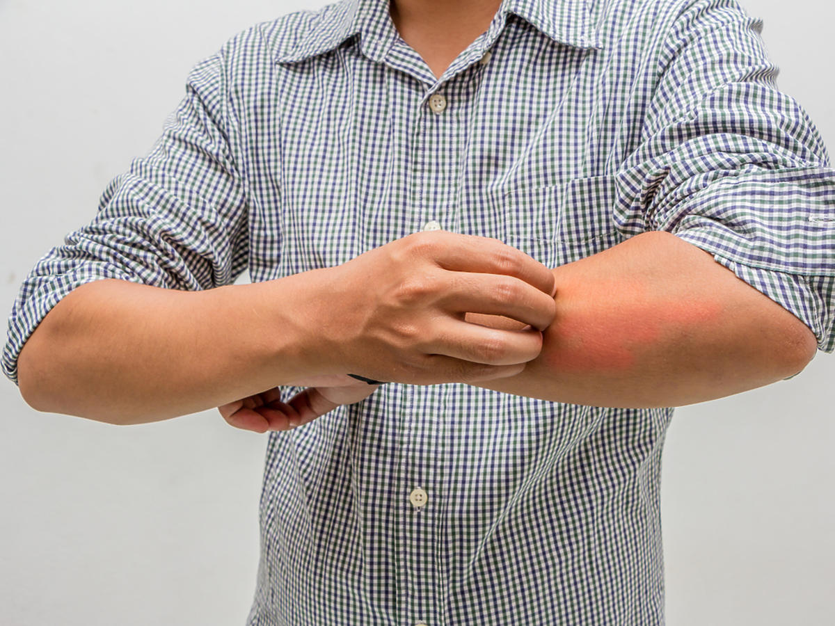 Mężczyzna drapie rękę zaczerwienioną po ugryzieniu owada.