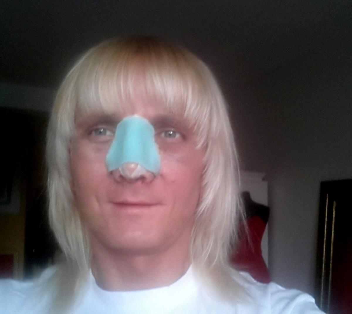 Piotr Krajewski po operacji plastycznej nosa