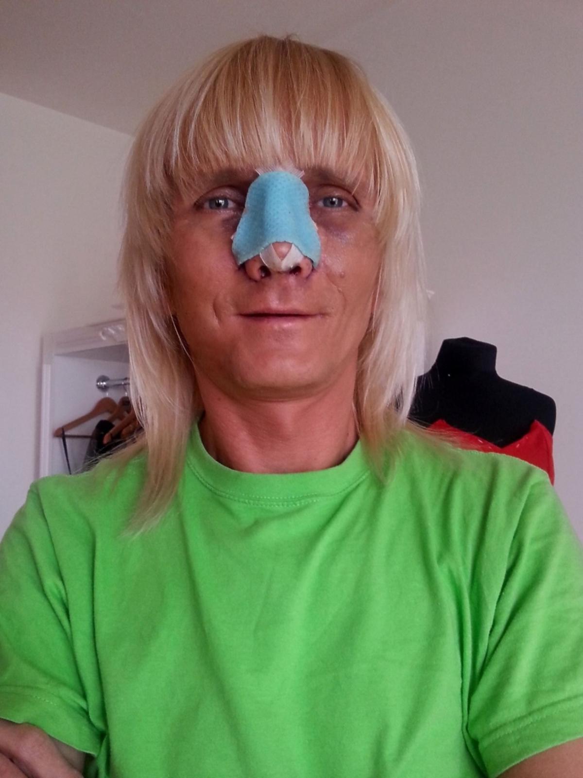 Piotr Krajewski po operacji plastycznej nosa
