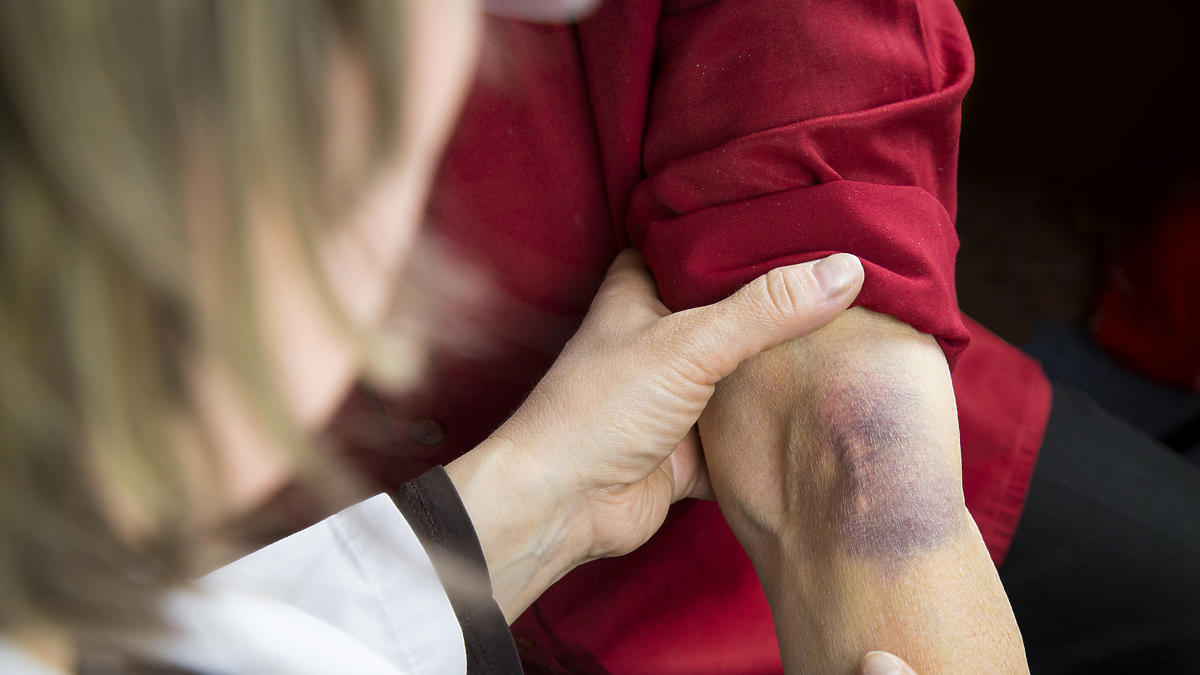 Jak Nazywa Się Skłonność Do Odnajdywania Przyjemności W Cierpieniu Skąd się bierze skłonność do siniaków?